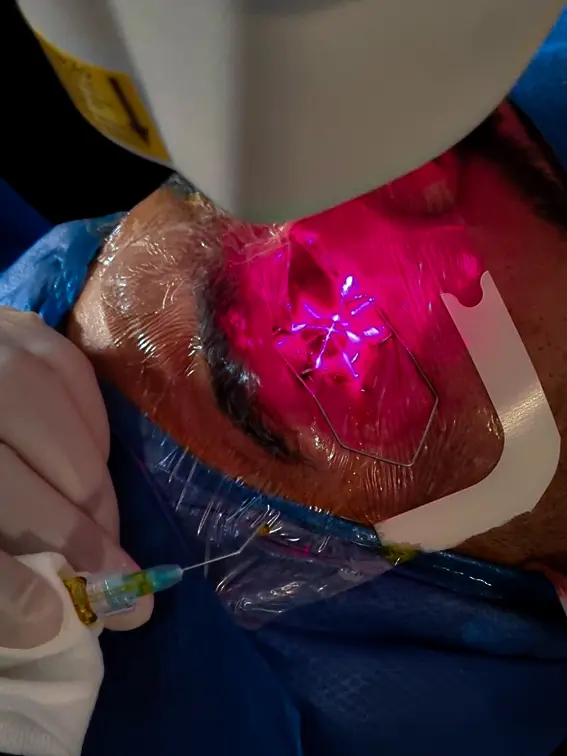 Corneal